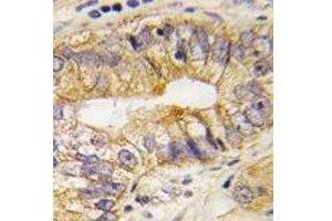 IHC analysis of FFPE human prostate carcinoma tissue stained with PDGFRA antibody (PDGFRA Antikörper  (AA 746-775))