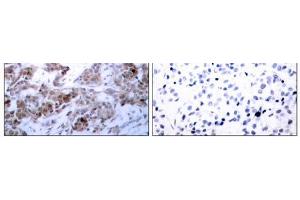 Immunohistochemical analysis of paraffin-embedded human breast carcinoma tissue using BCL-2 (Ab-70) antibody (E021060). (Bcl-2 Antikörper)