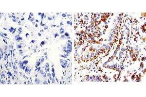 Immunohistochemistry analysis of Connexin 43 showing staining in the membrane of paraffin-embedded human lung adenocarcinoma (right) compared to a negative control without primary antibody (left). (Connexin 43/GJA1 Antikörper  (C-Term))