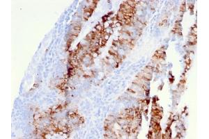 Formalin-fixed, paraffin-embedded human colon carcinoma stained with DR5 Mouse Monoclonal Antibody (DR5/3381). (TNFRSF10B Antikörper  (AA 266-393))