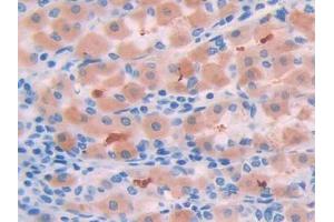 DAB staining on IHC-P; Samples: Human Stomach cancer Tissue (SERPINA6 Antikörper  (AA 25-195))