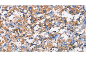 Immunohistochemistry of paraffin-embedded Human thyroid cancer tissue using PFKP Polyclonal Antibody at dilution 1:50 (PFKP Antikörper)