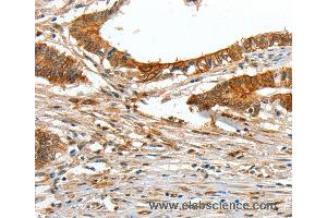Immunohistochemistry of Human lung cancer using COL1A2 Polyclonal Antibody at dilution of 1:70 (COL1A2 Antikörper)