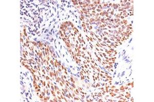 IHC staining of lung squamous cell carcinoma with p40 antibody. (p40 (p63 Delta) (AA 5-17) Antikörper)