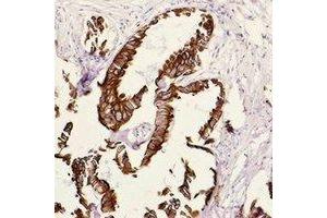 Immunohistochemical analysis of Cytokeratin 18 staining in human breast cancer formalin fixed paraffin embedded tissue section. (Cytokeratin 18 Antikörper)
