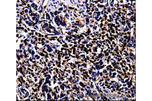 Immunohistochemistry of Human stomach cancer  using S100A4 Polyclonal Antibody at dilution of 1:100 (s100a4 Antikörper)