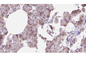 ABIN6273225 at 1/100 staining Human pancreas cancer tissue by IHC-P. (DCTN6 Antikörper  (Internal Region))