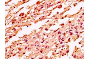 IHC image of nme1HU diluted at 1:50 and staining in paraffin-embedded human melanoma performed on a Leica BondTM system. (Histone H1-Like (LOC107807853) Antikörper)