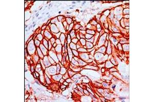 Anti-c-erbB2 Monoclonal Antibody - Immunohistochemistry  Anti-c-erbB2 Monoclonal Antibody (Rabbit) was used to detect c-erbB2 in human breast tumor tissue. (ErbB2/Her2 Antikörper  (Extracellular Domain))