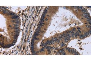 Immunohistochemistry of paraffin-embedded Human colon cancer tissue using FSTL1 Polyclonal Antibody at dilution 1:30 (FSTL1 Antikörper)