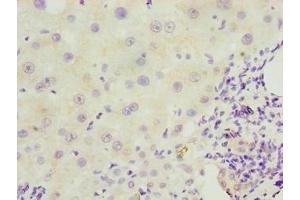 Immunohistochemistry of paraffin-embedded human liver cancer using ABIN7151406 at dilution of 1:100 (EFCAB12 Antikörper  (AA 1-200))