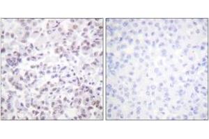 Immunohistochemistry analysis of paraffin-embedded human breast carcinoma tissue, using Histone H2B (Ab-12) Antibody. (Histone H2B Antikörper  (AA 10-59))