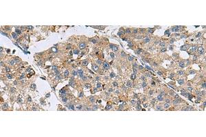 Immunohistochemistry of paraffin-embedded Human liver cancer tissue using MED31 Polyclonal Antibody at dilution of 1:100(x200) (MED31 Antikörper)