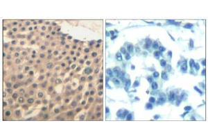 Immunohistochemical analysis of paraffin-embedded human lung carcinoma tissue using HDAC4/HDAC5/HDAC9 (Ab-246/259/220) Antibody (E021517). (HDAC4/HDAC5/HDAC9 Antikörper)