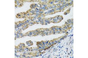 Immunohistochemistry of paraffin-embedded human gastric cancer using TXN2 antibody (ABIN5974110) at dilution of 1/100 (40x lens). (TXN2 Antikörper)