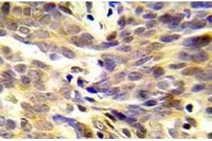 Immunohistochemistry (IHC) analyzes of p-BRCA1 antibody in paraffin-embedded human lung adenocarcinoma tissue. (BRCA1 Antikörper  (pSer1423))