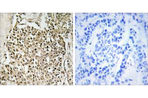 Peptide - +Immunohistochemistry analysis of paraffin-embedded human breast carcinoma tissue using CEP350 antibody. (CEP350 Antikörper)