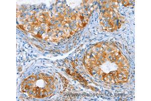 Immunohistochemistry of Human thyroid cancer using AIP Polyclonal Antibody at dilution of 1:80 (AIP Antikörper)