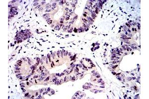 Immunohistochemical analysis of paraffin-embedded colon cancer tissues using BIRC5 mouse mAb with DAB staining. (Survivin Antikörper)