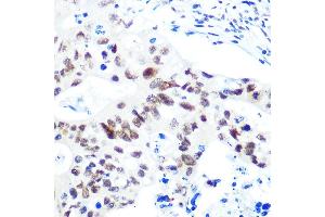 Immunohistochemistry of paraffin-embedded human colon carcinoma using HD Rabbit mAb (ABIN1680476, ABIN3015870, ABIN3015871 and ABIN7101453) at dilution of 1:100 (40x lens). (HDAC9 Antikörper)