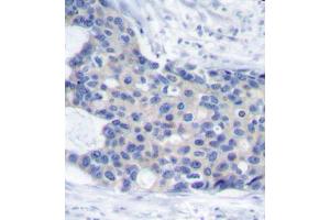 Immunohistochemistry of paraffin-embedded human breast carcinoma tissue, using Phospho-ZAP70-Y493 antibody (ABIN2988352). (ZAP70 Antikörper  (pTyr493))