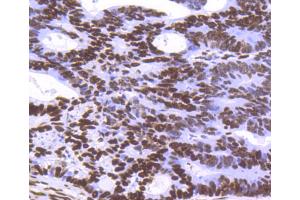 Paraformaldehyde-fixed, paraffin embedded Human breast carcinoma tissue, Antigen retrieval by boiling in sodium citrate buffer (pH6) for 15min, Block endogenous peroxidase by 3% hydrogen peroxide for 30 minutes, Blocking buffer at 37°C for 20min, Antibody incubation with Histone H3. (Histone H3.3 Antikörper)