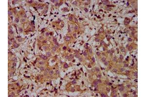 IHC image of ABIN7150047 diluted at 1:400 and staining in paraffin-embedded human liver cancer performed on a Leica BondTM system. (Adam23 Antikörper  (AA 498-647))