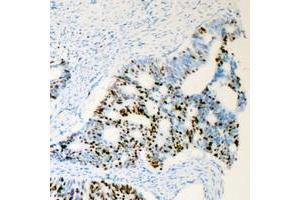 Immunohistochemical analysis of Androgen Receptor (pS650) staining in human prostate cancer formalin fixed paraffin embedded tissue section. (Androgen Receptor Antikörper  (pSer650))