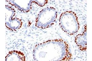 IHC testing of FFPE human prostate cancer with p40 antibody. (p40 (p63 Delta) (AA 5-17) Antikörper)