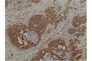 Immunohistochemical analysis of paraffin-embedded Human Breast Carcinoma using P44/42 MAPK (ERK1/2) Mouse mAb diluted at 1:200. (ERK1/2 Antikörper)