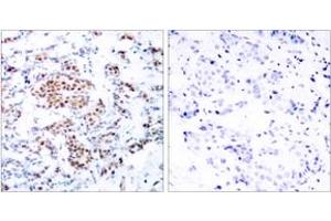 Immunohistochemistry analysis of paraffin-embedded human breast carcinoma tissue, using STAT5A (Ab-694) Antibody. (STAT5A Antikörper  (AA 666-715))
