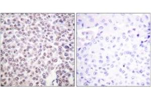 Immunohistochemistry analysis of paraffin-embedded human breast carcinoma tissue, using Histone H2B (Ab-5) Antibody. (Histone H2B Antikörper  (AA 1-50))