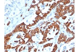 Immunohistochemistry (IHC) image for anti-Epithelial Cell Adhesion Molecule (EPCAM) (AA 20-60), (N-Term) antibody (ABIN6939994)