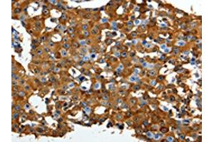 The image on the left is immunohistochemistry of paraffin-embedded Human breast cancer tissue using ABIN7191316(LRP1 Antibody) at dilution 1/90, on the right is treated with synthetic peptide. (LRP1 Antikörper)