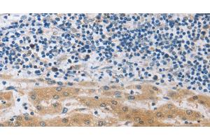 Immunohistochemistry of paraffin-embedded Human liver cancer using MUC20 Polyclonal Antibody at dilution of 1:40 (MUC20 Antikörper)
