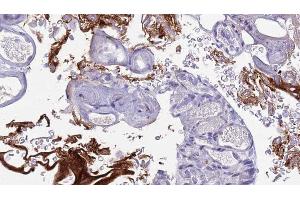ABIN6273442 at 1/100 staining Human urothelial cancer tissue by IHC-P. (CD177 Antikörper  (Internal Region))