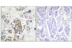 Immunohistochemical analysis of paraffin-embedded human breast carcinoma tissue, using ITGB4 (Phospho-Tyr1510) antibody (left)or the same antibody preincubated with blocking peptide (right). (Integrin beta 4 Antikörper  (pTyr1510))