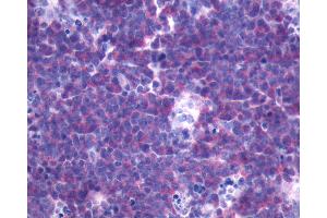 Anti-FPR3 / FPRL2 antibody IHC of human Lymph Node, Non-Hodgkins Lymphoma. (FPR3 Antikörper  (N-Term))