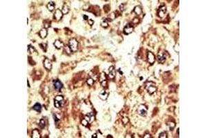 IHC analysis of FFPE human hepatocarcinoma tissue stained with the WEE1 antibody (WEE1 Antikörper  (AA 604-634))