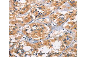 Immunohistochemistry of Human cervical cancer using AHR Polyclonal Antibody at dilution of 1:50 (Aryl Hydrocarbon Receptor Antikörper)