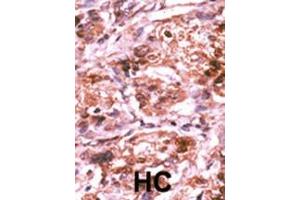 Formalin-fixed and paraffin-embedded human cancer tissue reacted with the primary antibody, which was peroxidase-conjugated to the secondary antibody, followed by AEC staining. (CDC25A Antikörper  (pSer293))