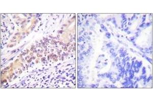 Immunohistochemistry analysis of paraffin-embedded human lung carcinoma tissue, using TOP2B Antibody. (TOP2B Antikörper  (AA 1-50))