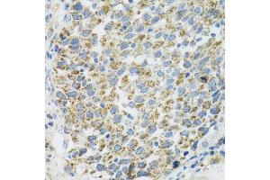 Immunohistochemistry of paraffin-embedded human lung cancer using TXN2 antibody (ABIN5974110) at dilution of 1/100 (40x lens). (TXN2 Antikörper)