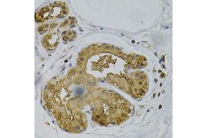 Immunohistochemistry of paraffin-embedded human breast cancer using PSEN1 Antibody (ABIN5971213) at dilution of 1/100 (40x lens). (Presenilin 1 Antikörper)