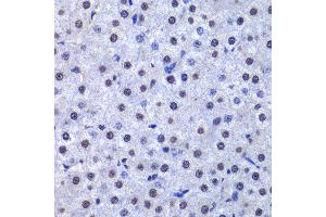 Immunohistochemistry of paraffin-embedded human liver cancer using GSTP1 antibody at dilution of 1:200 (400x lens). (GSTP1 Antikörper)