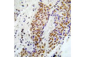 Immunohistochemical analysis of paraffin-embedded human lung adenocarcinoma tissue using ASK1 (Phospho-Ser966) Antibody (E012059). (ASK1 Antikörper  (pSer966))