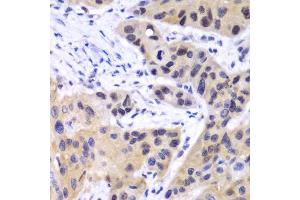 Immunohistochemistry of paraffin-embedded human esophageal cancer using IRF3 antibody. (IRF3 Antikörper  (AA 1-260))