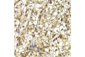 Immunohistochemistry of paraffin-embedded human kidney cancer using SULT2B1 antibody at dilution of 1:100 (x40 lens). (SULT2B1 Antikörper)
