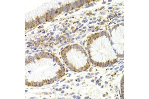 Immunohistochemistry of paraffin-embedded human gastric cancer using KISS1R Antibody (ABIN5971525) at dilution of 1/200 (40x lens). (KISS1R Antikörper)