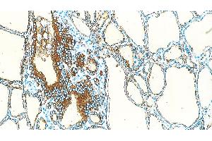 Human Thyriod: immunohistochemical staining of Thyroglobulin in the follicular epithelial cells. (Thyroglobulin Antikörper)